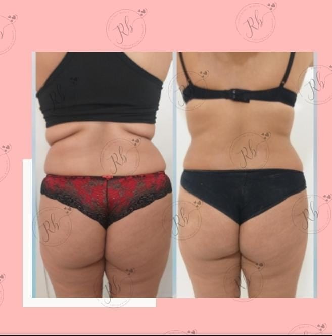 Evolução do tratamento de crio - Foto 4